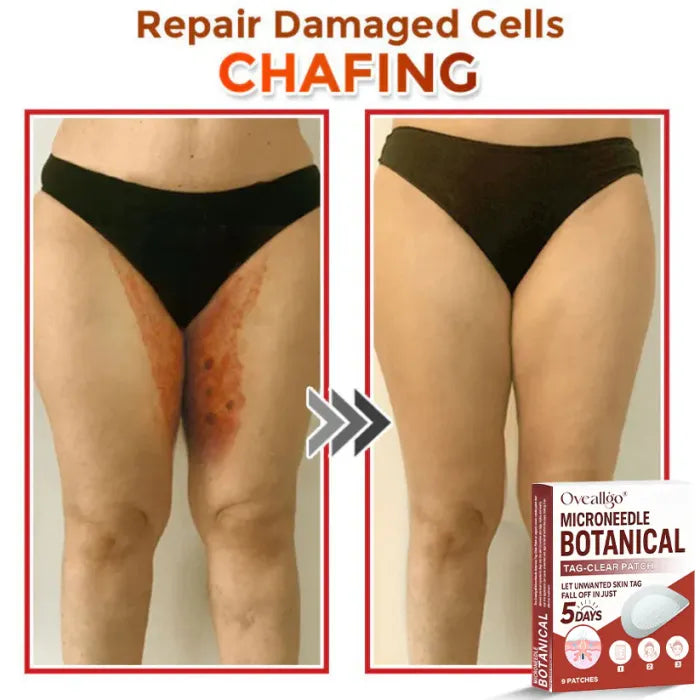 LBMLBM® MicroNeedle Botanic Skin Tag Removal Patch