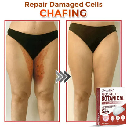 LBMLBM® MicroNeedle Botanic Skin Tag Removal Patch